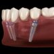 A close-up of dental implants and dentures, highlighting oral health and dental care.