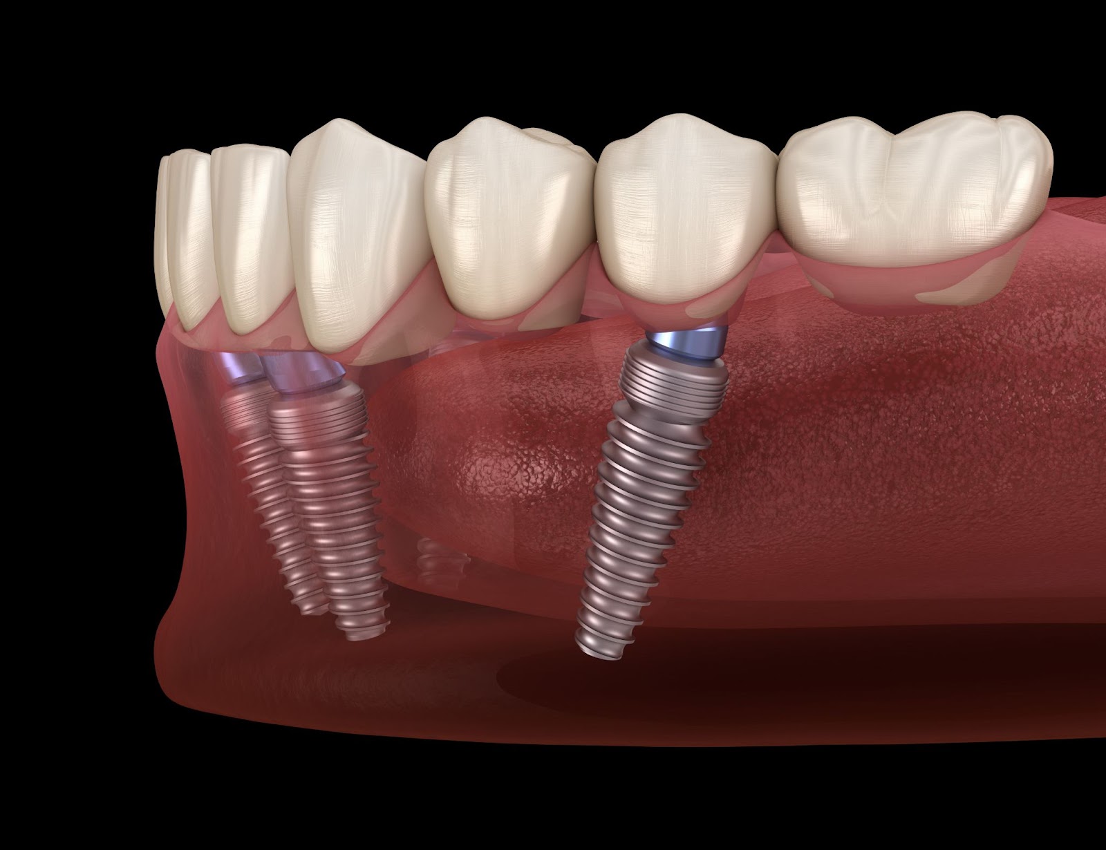 15 Reasons to Get Dental Implants for Missing or Affected Teeth