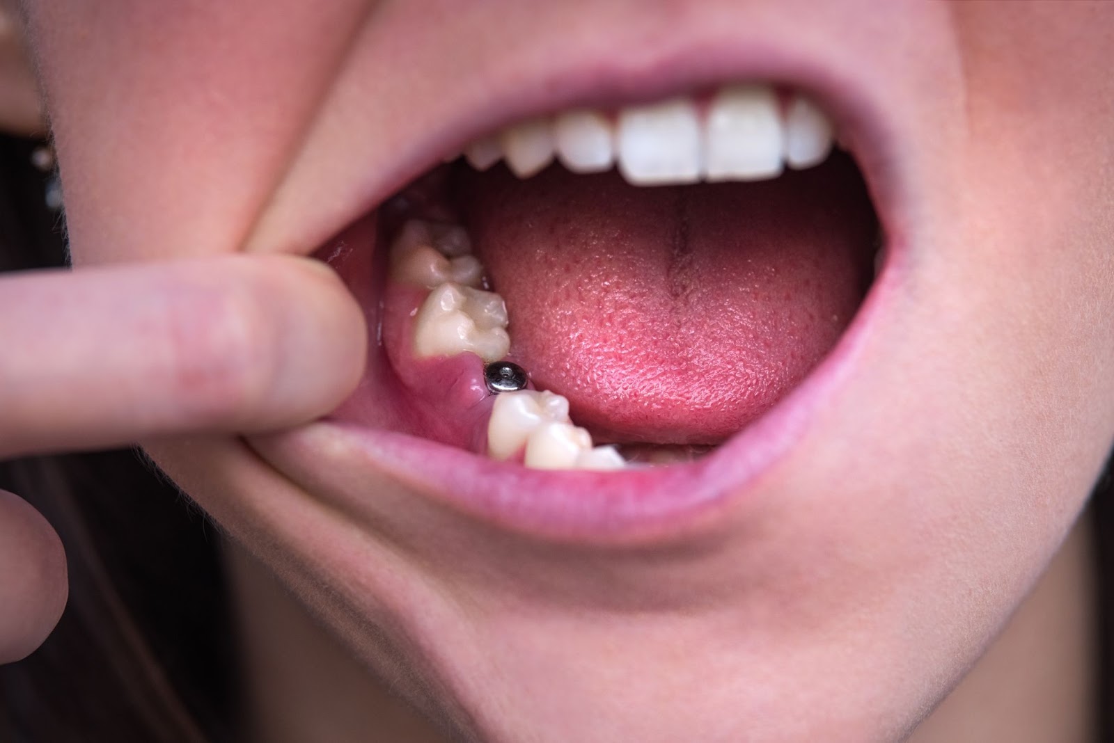 An image showing dental implants and dentures, emphasizing the importance of oral health.