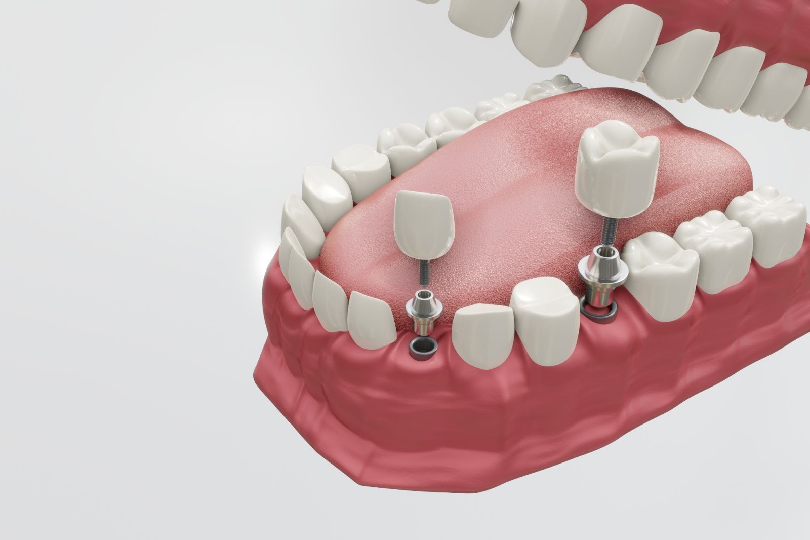 Image of dental implants and dentures, highlighting importance of oral health.