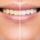 Promote whiter teeth with effective teeth whitening methods for a brighter smile.