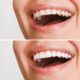 A woman with white teeth before and after teeth whitening at family dental.