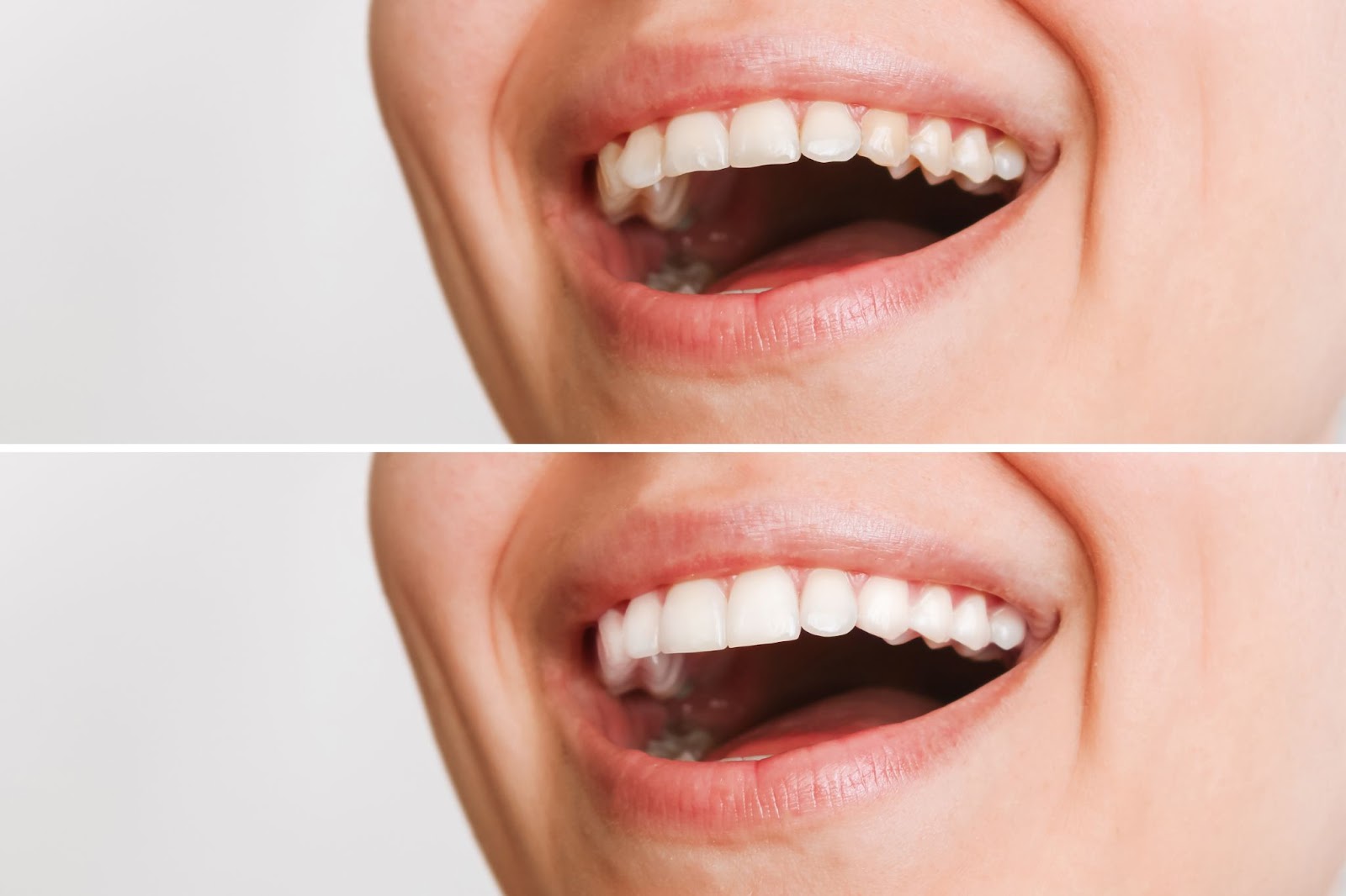 Transform Your Smile with Porcelain Veneers: A Comprehensive Guide