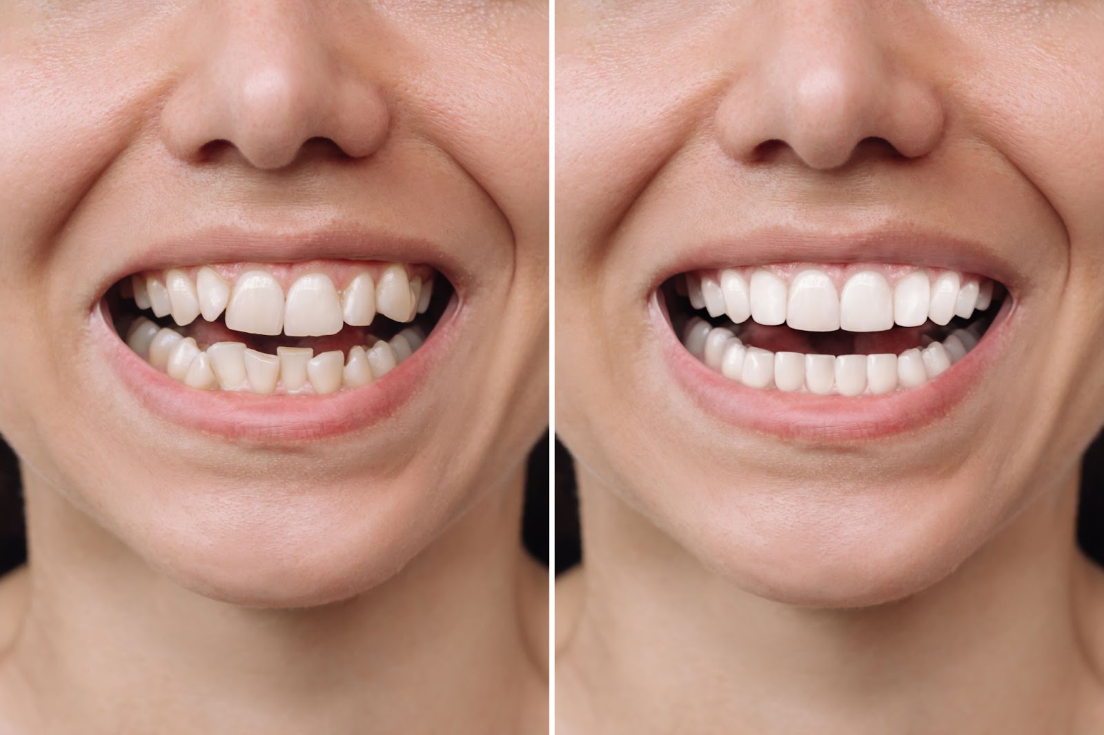 Transformation from stained to bright white teeth after professional teeth whitening at family dental office.