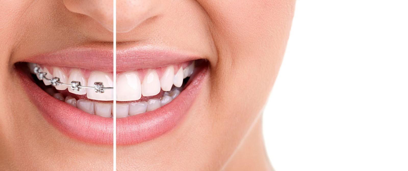 The Pros and Cons of Six Month Braces