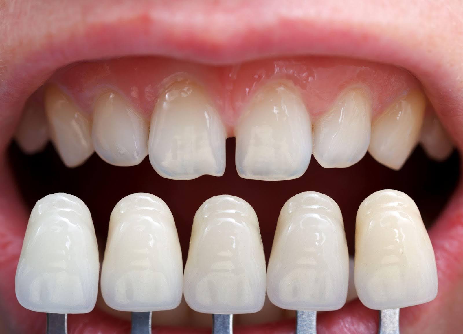 A close-up of a bright smile with white veneers, highlighting dental aesthetics