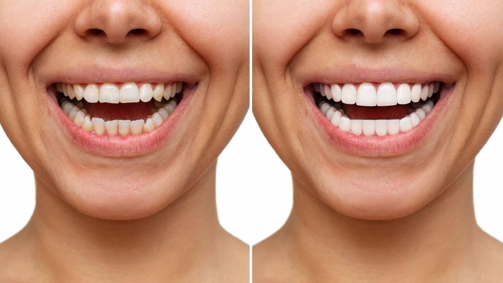 Visual of teeth pre- and post-whitening, highlighting enhanced whiteness