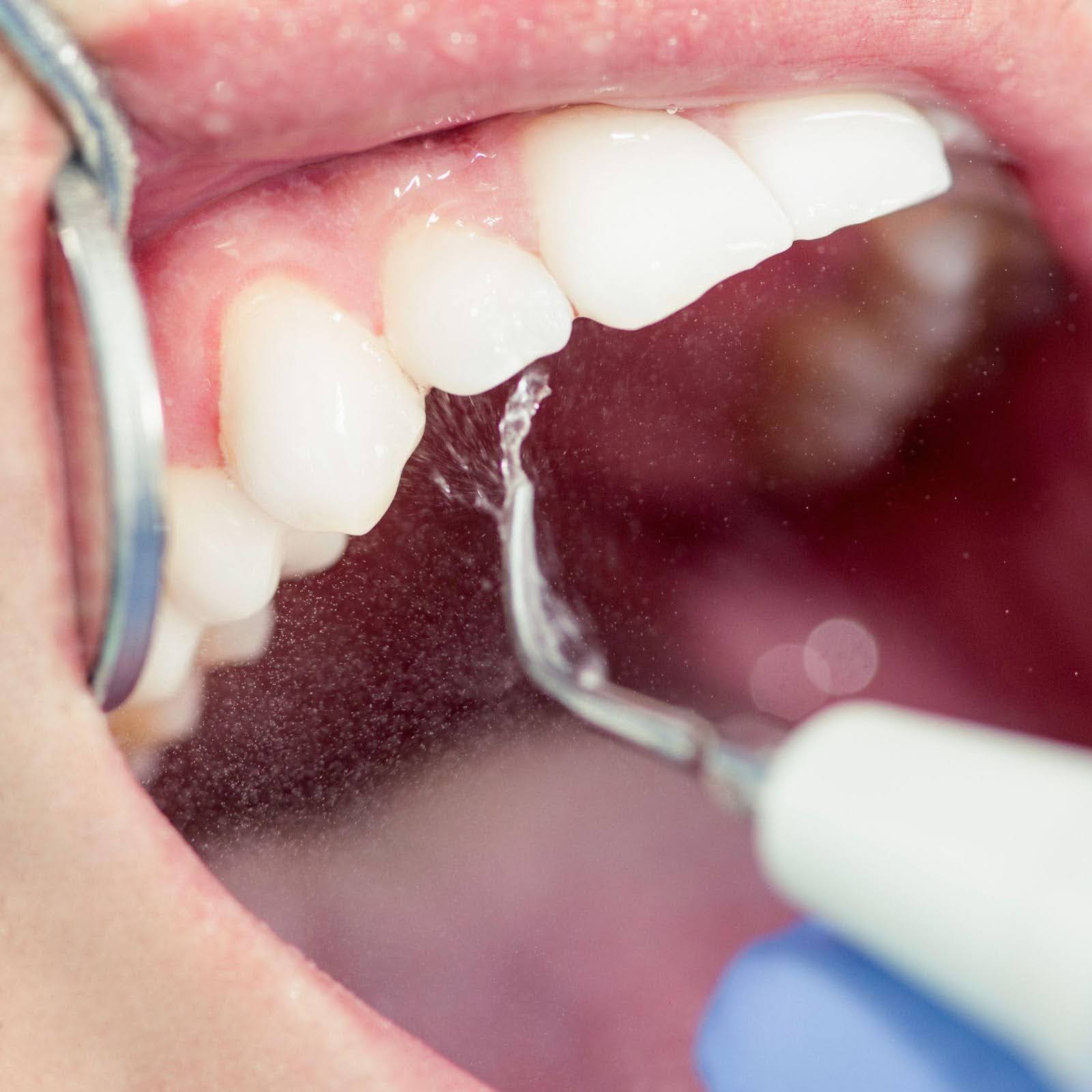 A person cleans their teeth with a dental tool for optimal hygiene